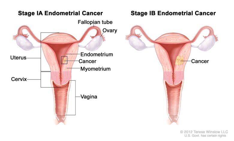 Endometrial Cancer