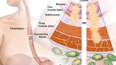 Esophageal Cancer