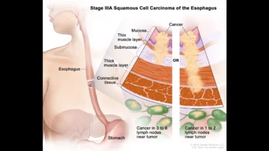 Esophageal Cancer