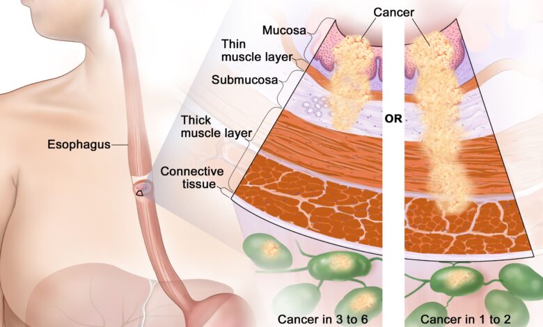 Esophageal Cancer