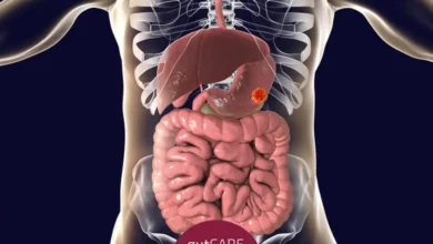 Stomach Cancer