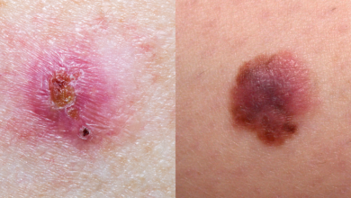 Skin Cancer