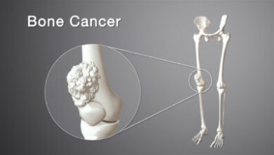 bone cancer​