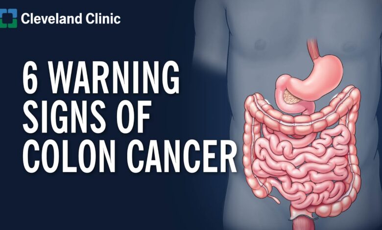 signs of colon cancer